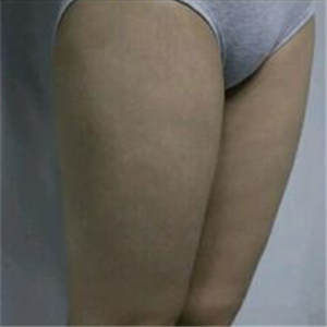 去找東方和諧馮斌做了大腿抽脂，分享一下果吧！